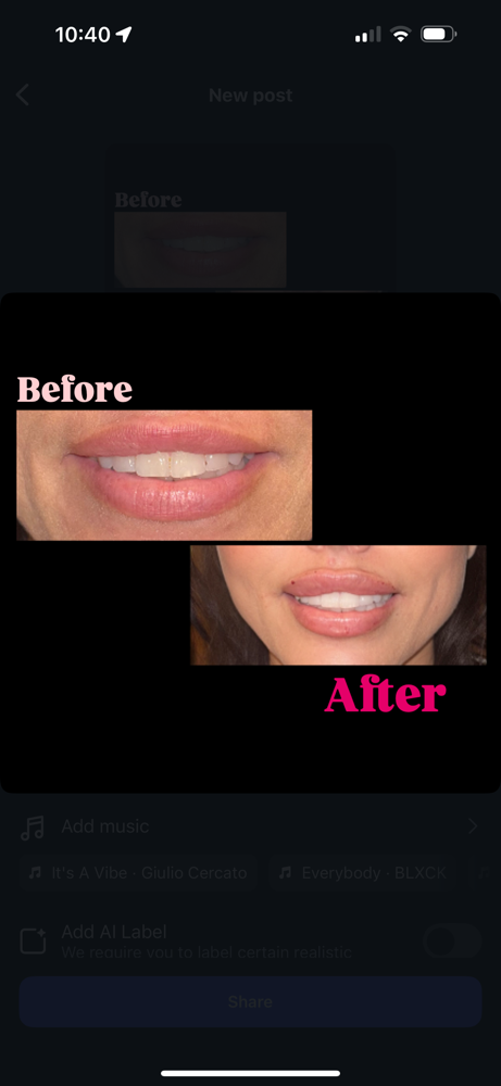 Full Syringe- Lip filler