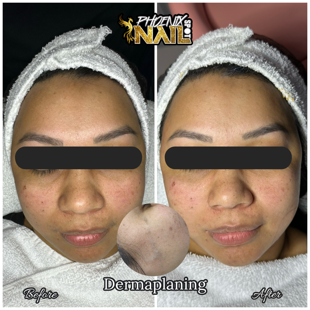Dermaplaning Facial