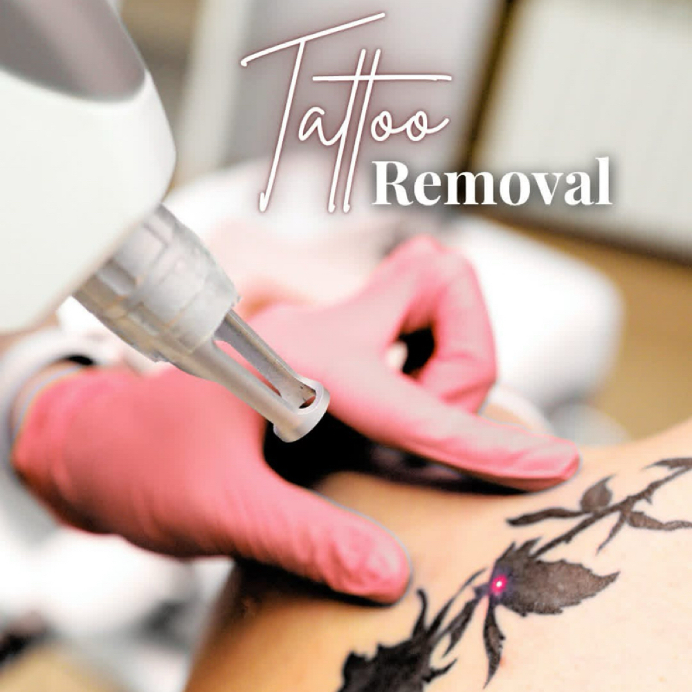 Laser Tattoo Removal at ARock Beauty & Wellness in San Angelo, TX