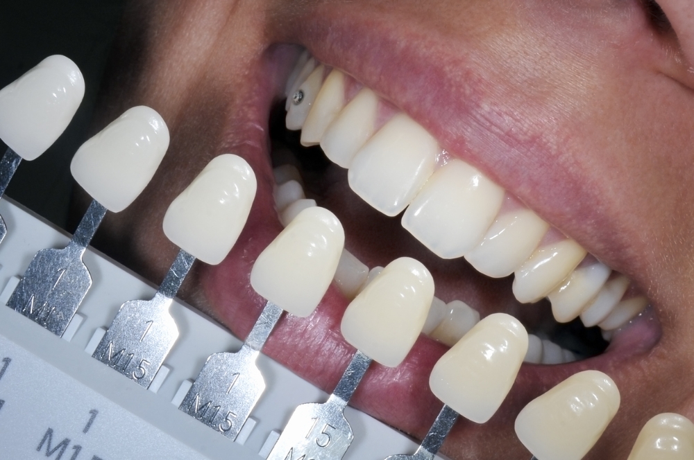 Standard Teeth Whitening and 1 Gem