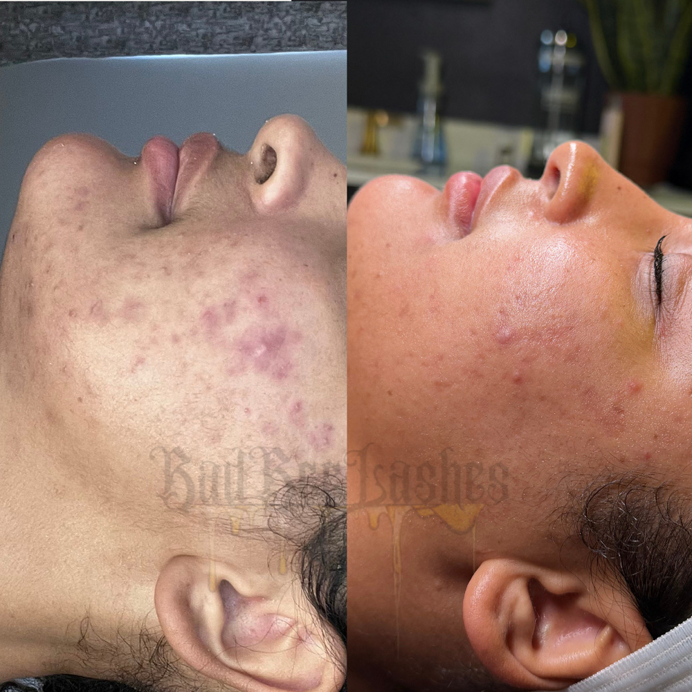 Hyperpigmentation/Melasma Sponsor at BadBeeLashes in Temecula, CA