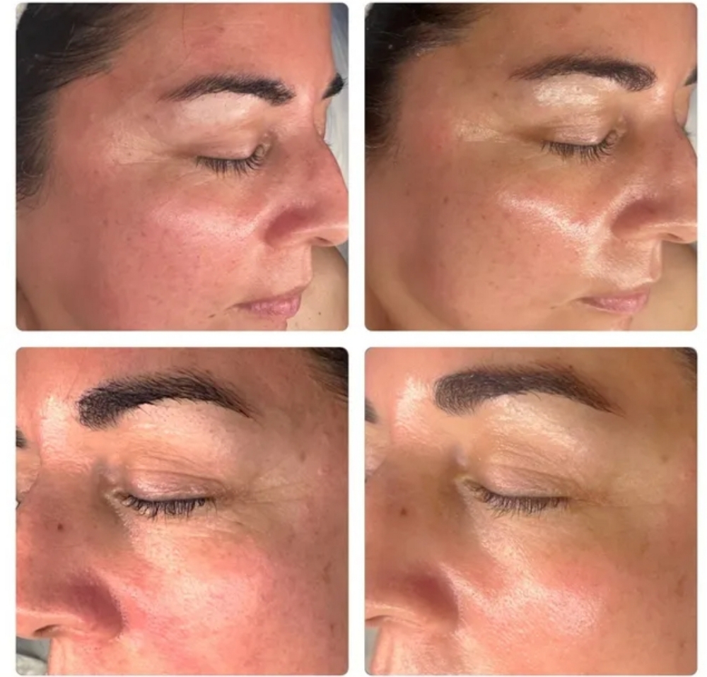 Carboxy Treatment CO2