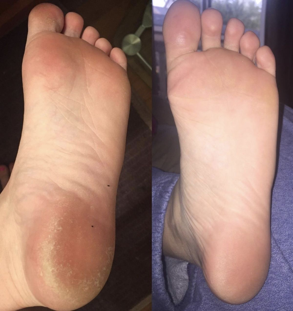 Callous Treatment for Dry hard skin