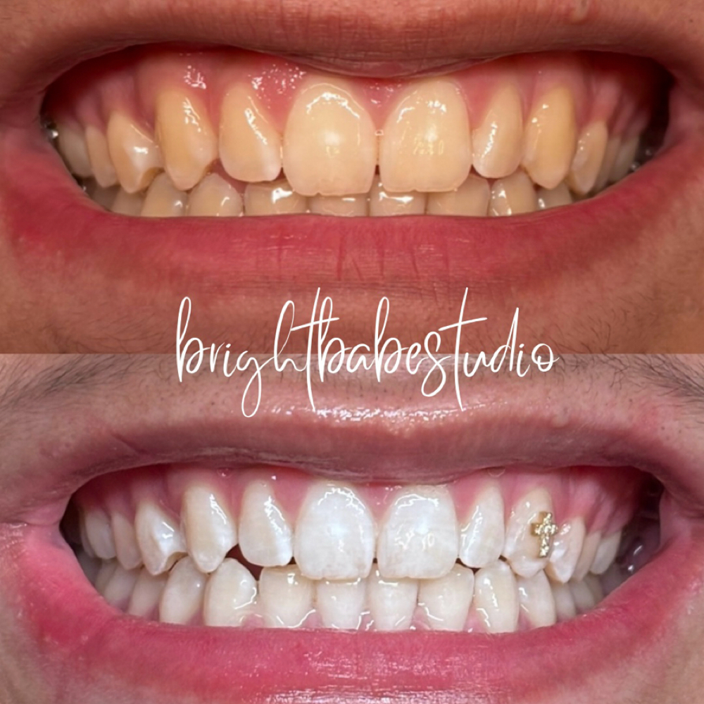 Teen Glow Whitening (Ages 13-17) at Bright Babe Studio in Alice, TX