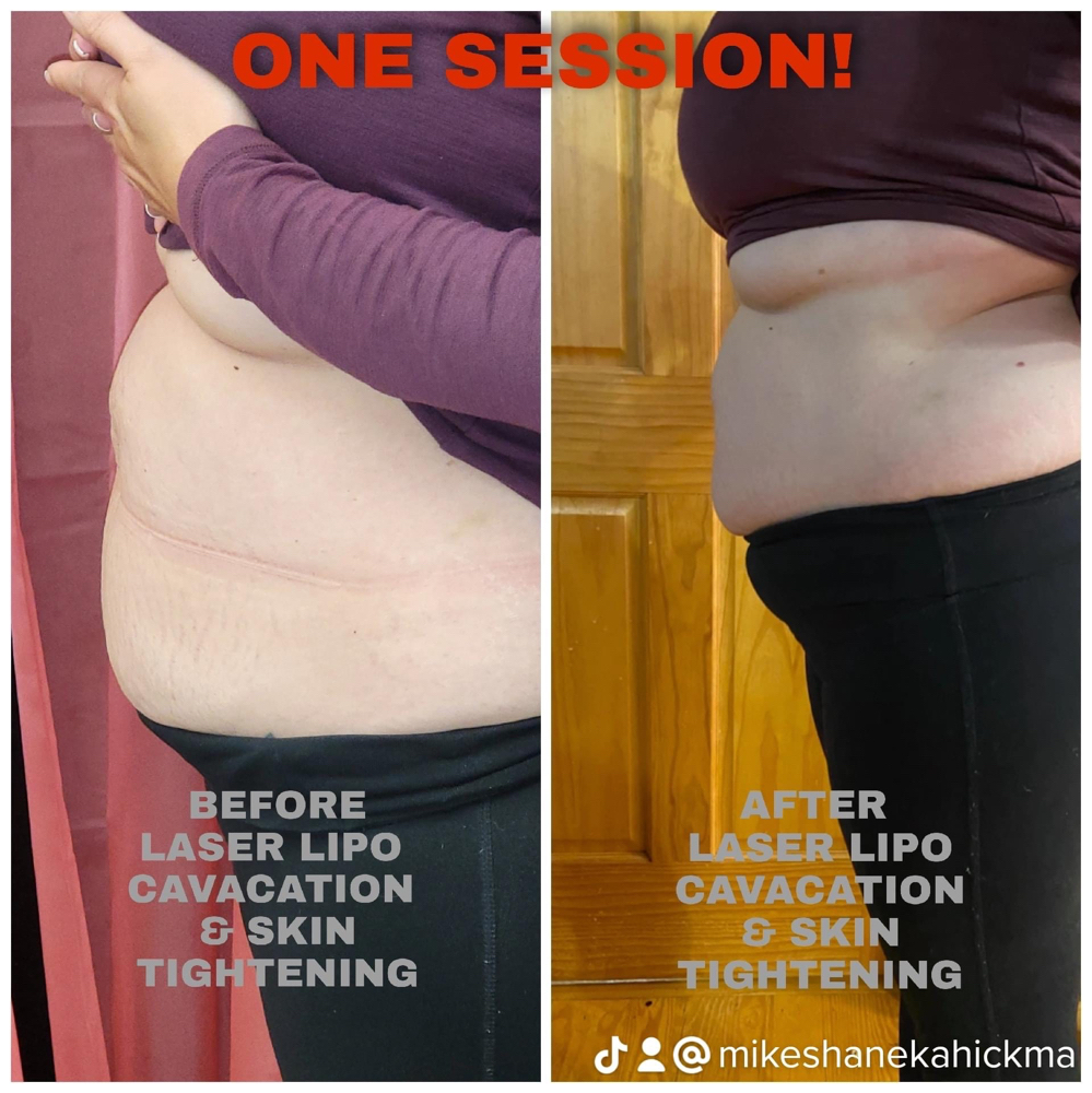 Stomach Reduction