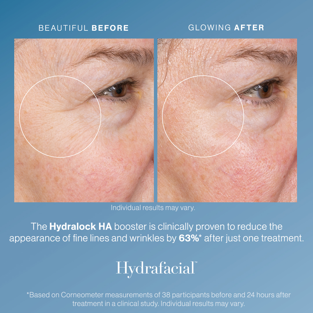 Hydrafacial that is for "Everyone"