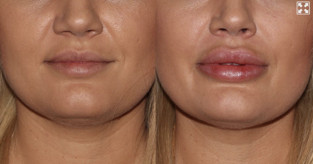 Juvederm Vobella