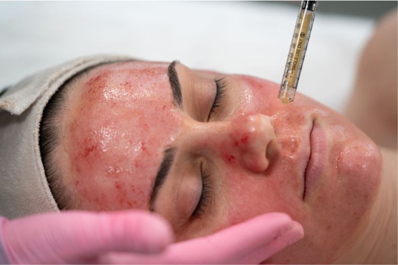 PRP Facial Rejuvenation