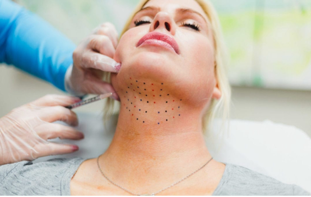 Kybella 1 Vial