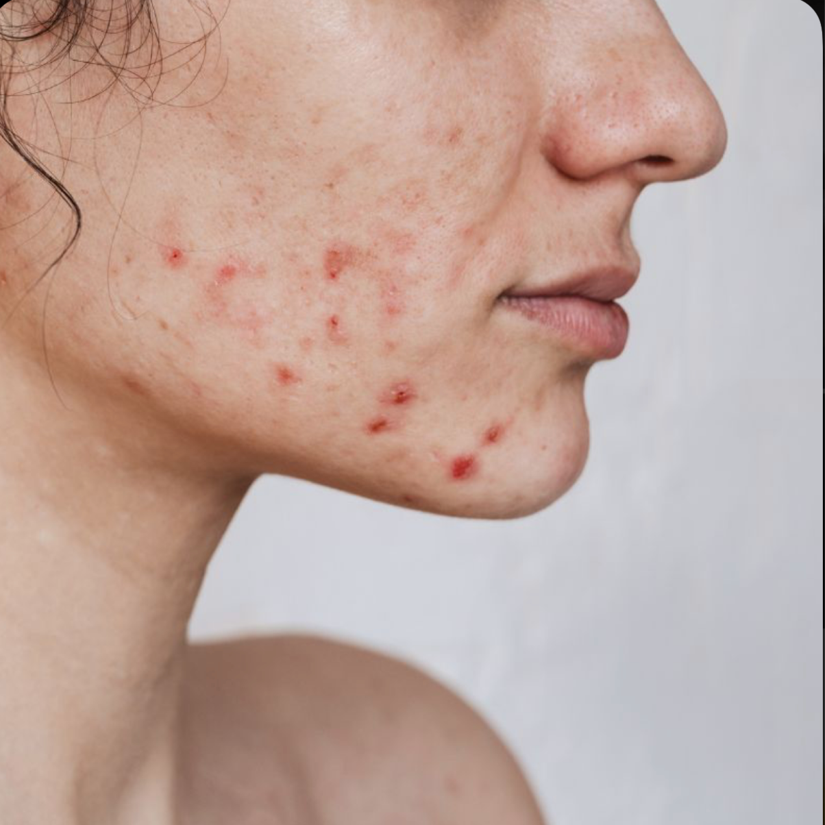 The Acne Treatment at The Glo Haus Atlanta in Atlanta, GA