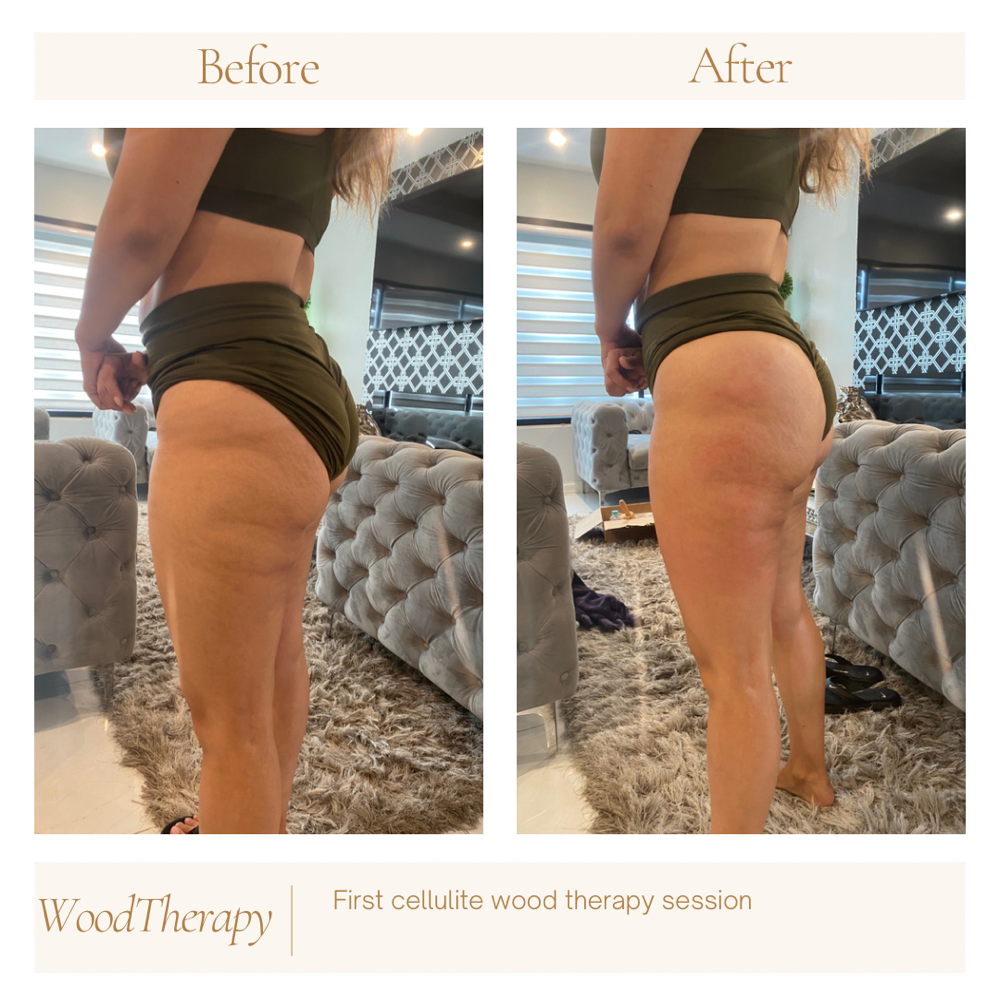 Cellulite Sculpting Treatment