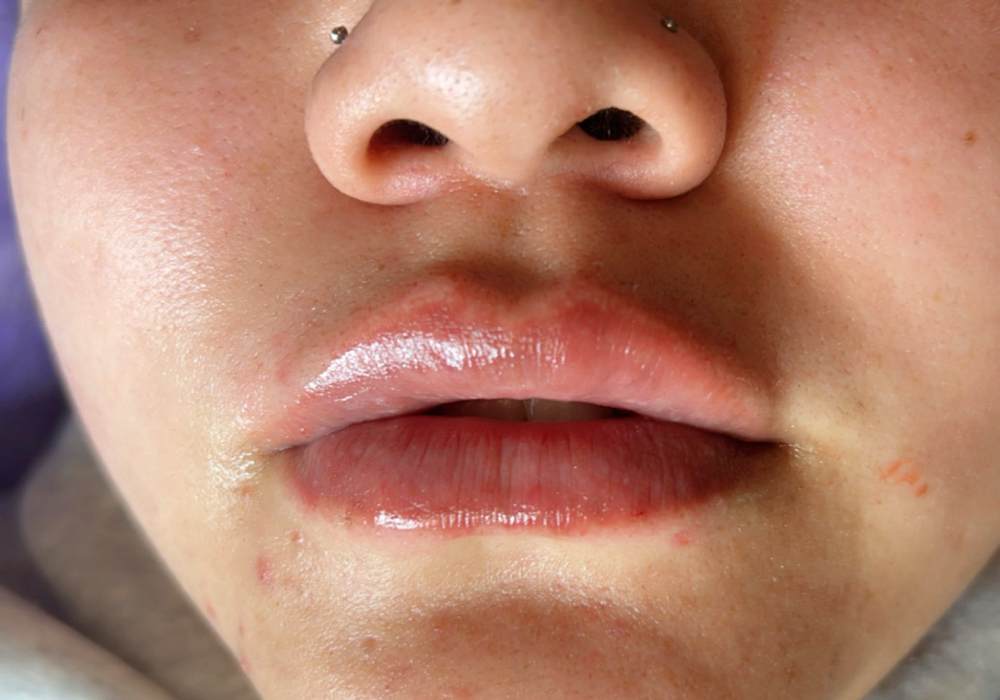 Lip Filler Basic