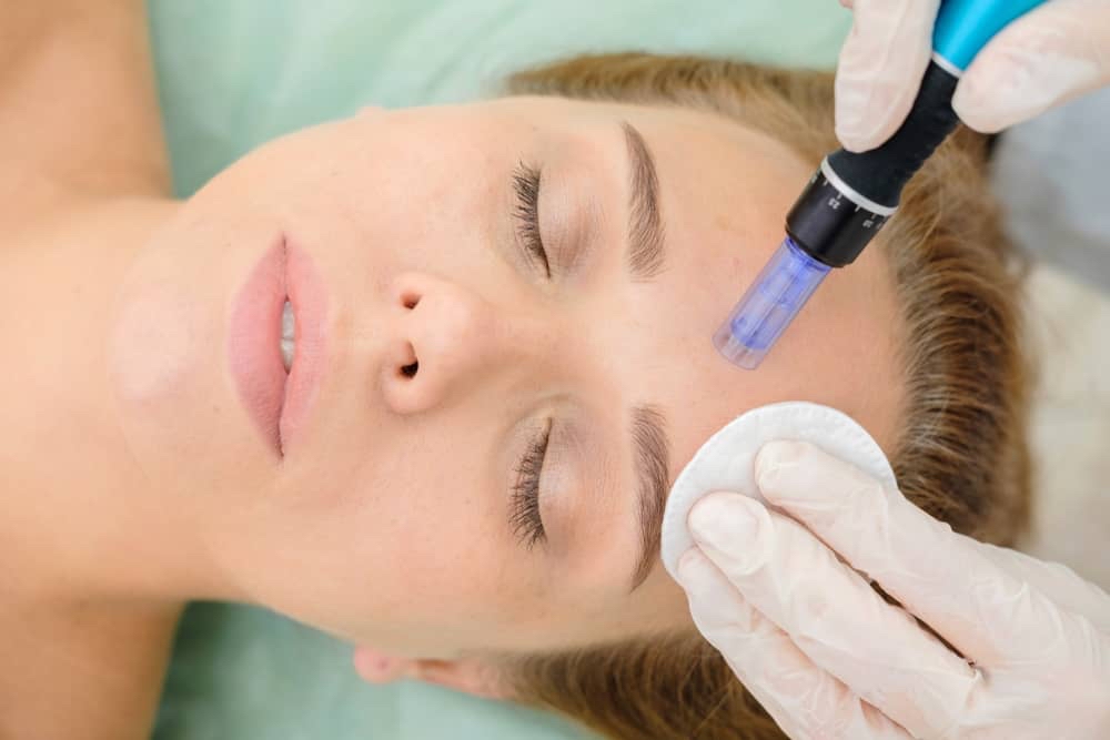 Microneedling with peel