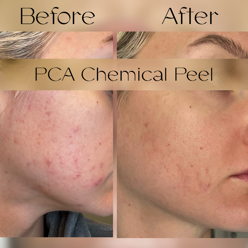 5 Sessions of PCA Chemical Peel