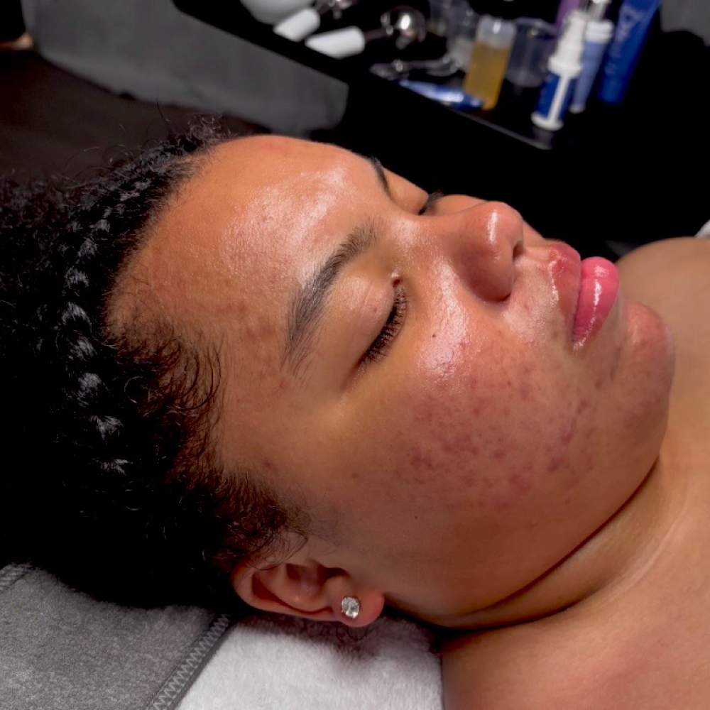 Clear Skin Facial at EstibyJos in Wauwatosa, WI