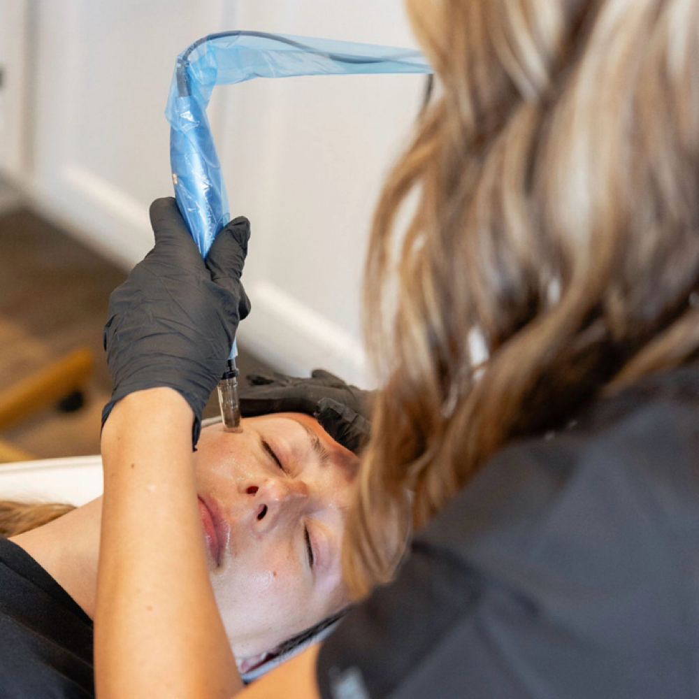 Microneedling Single Session at KB Aesthetics PLLC in Brighton, MI