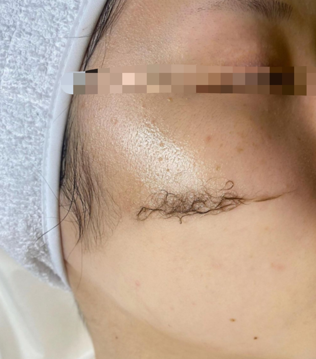 Dermaplaning add-on