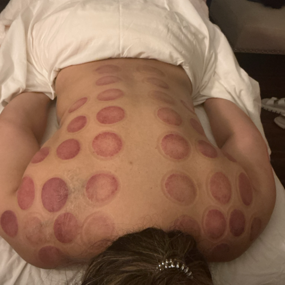 90 Mins Cupping at Valencia Muscular Therapy in San Antonio, TX