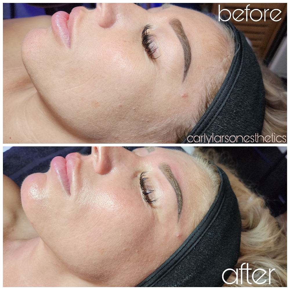 Ultra-glow Dermaplaning Facial at Carly Larson Esthetics in Temecula, CA