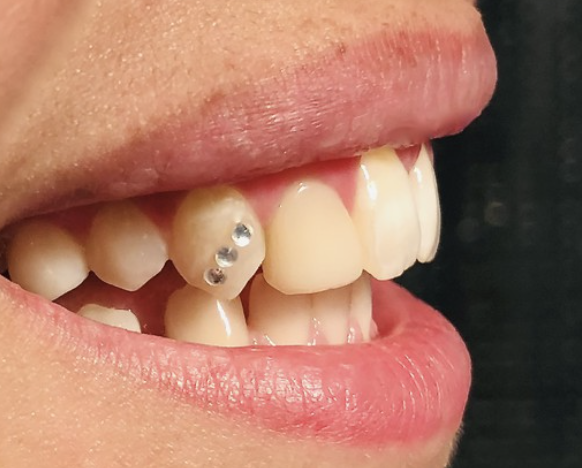 Small Tooth Gem Design