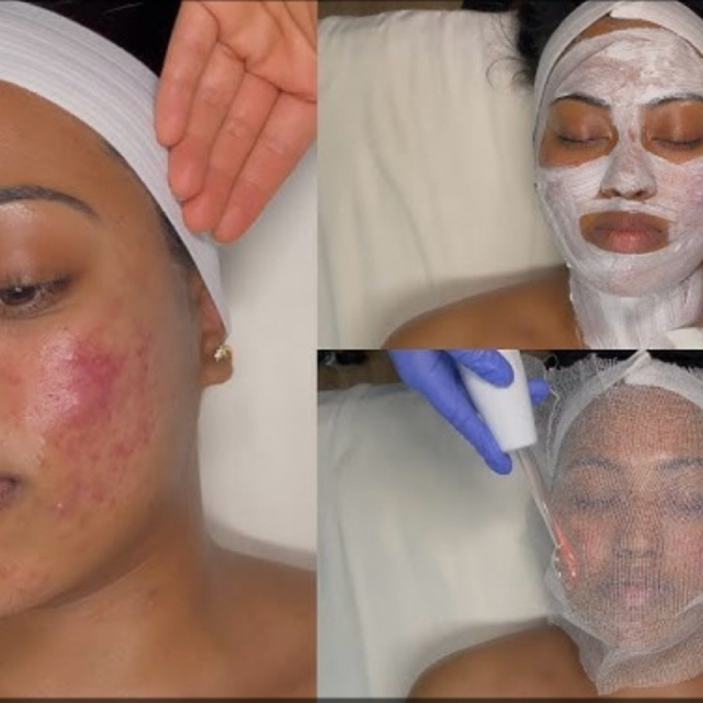 Acne Rescue Facial at Coastal Beauty Spa in Riverview, FL