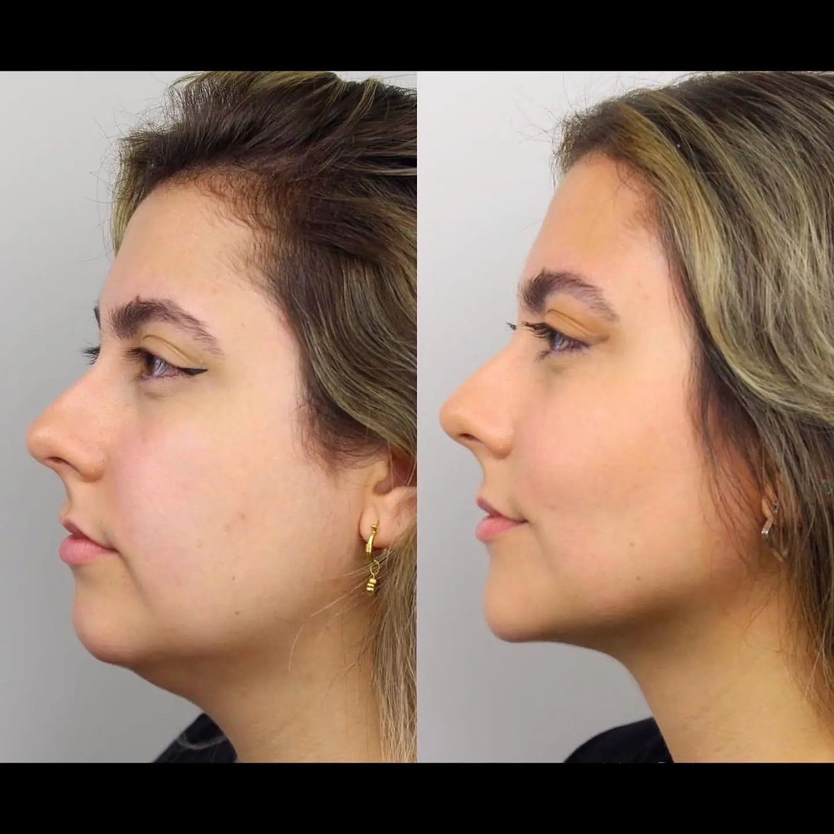 Jowls