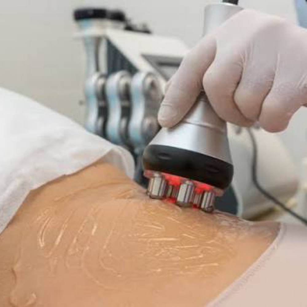 Radio Frequency Body Tightening at WaxLand & BodySculpting in Los Angeles, CA