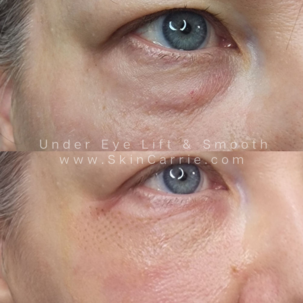 Under Eye Lift & Smooth