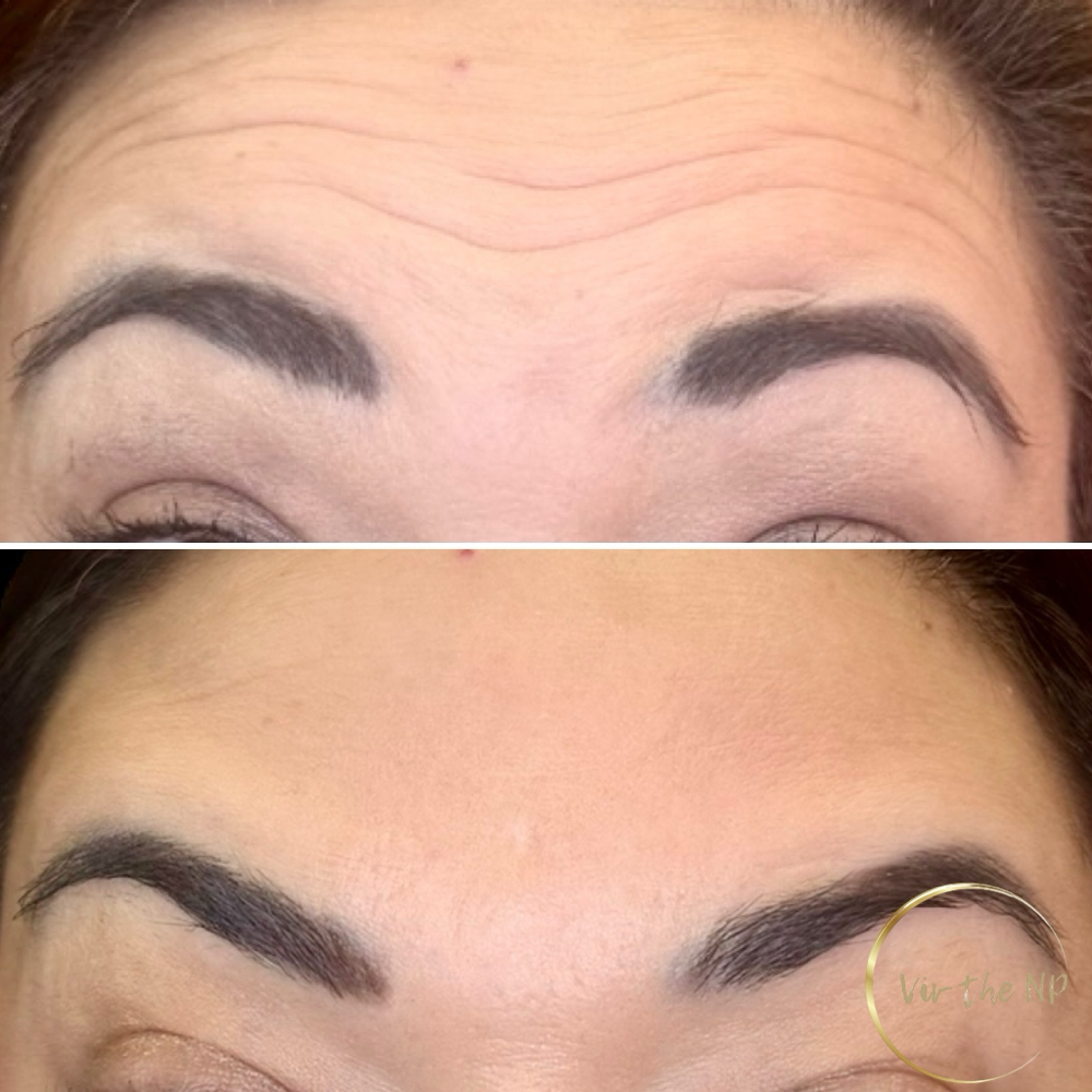 Botox 10.50/unit