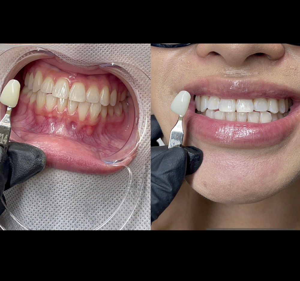 Platium Teeth Whitening