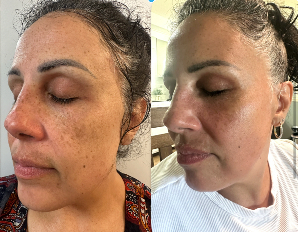 Melanopro at Angelic Esthetics LLC in Waterloo, NY