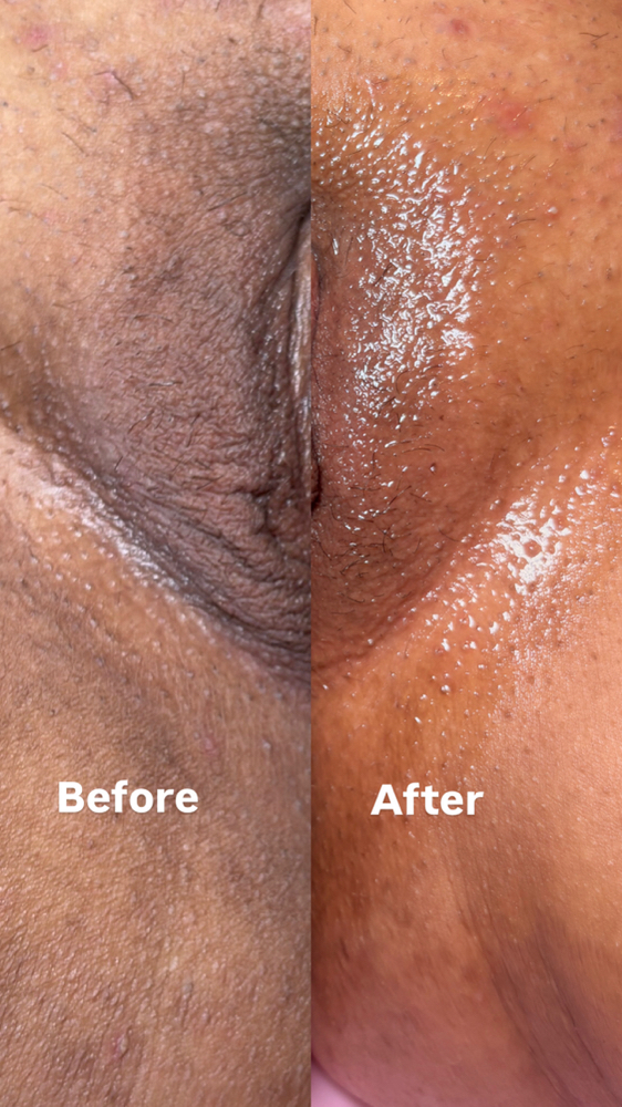 Brazilian Skin Lightening at Bare With Me in Upland, CA