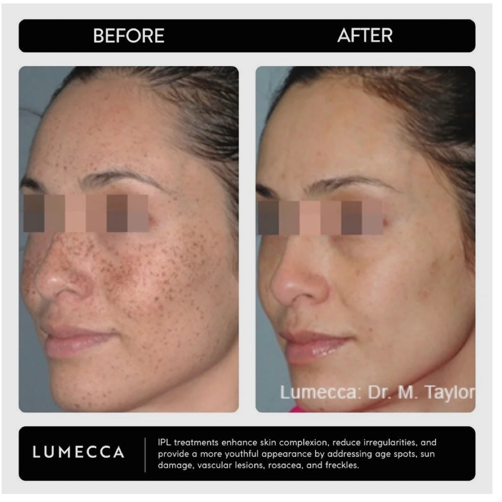 Lumecca Peak Facial at Remake Beauty Studio Mcallen in McAllen, TX