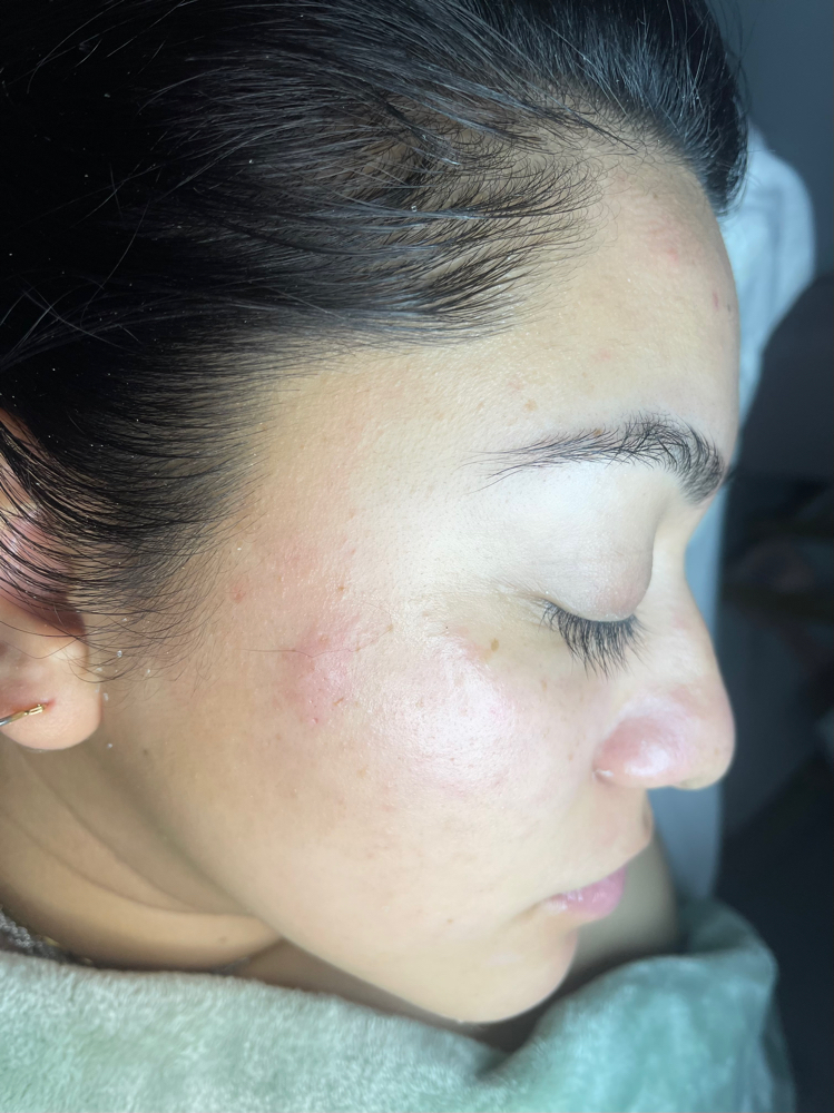 Customized Facial + Dermplane