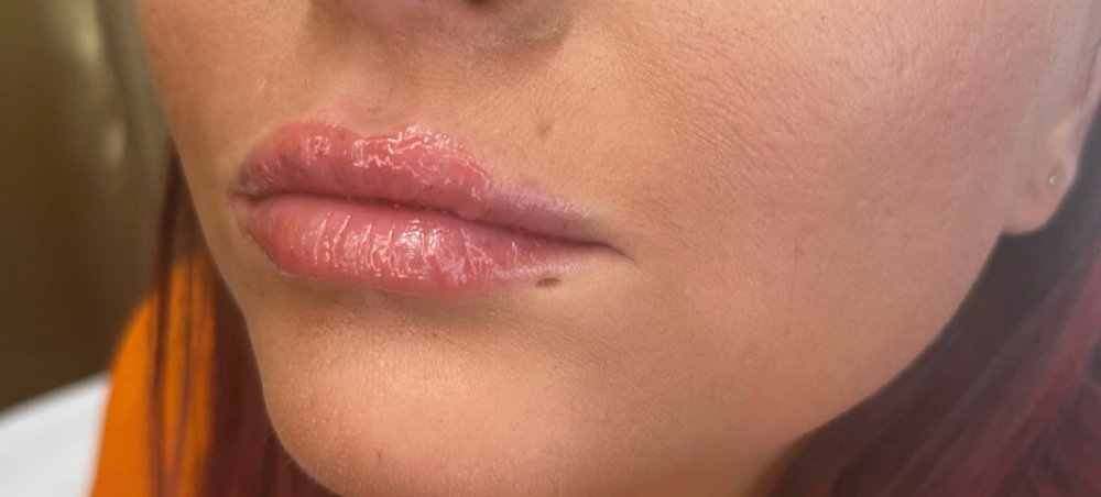 Hyaluronic Lip Filler