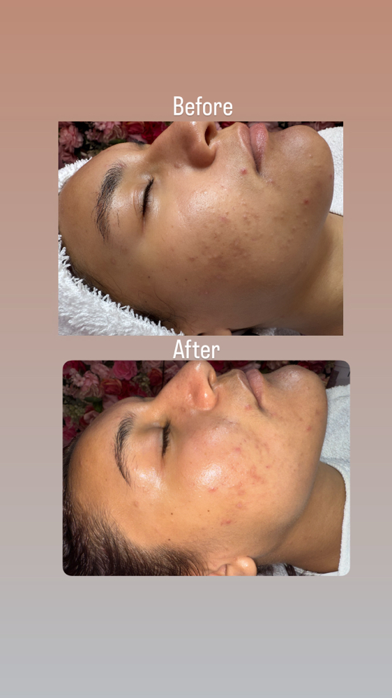 Diamond Microdermabrasion Facial