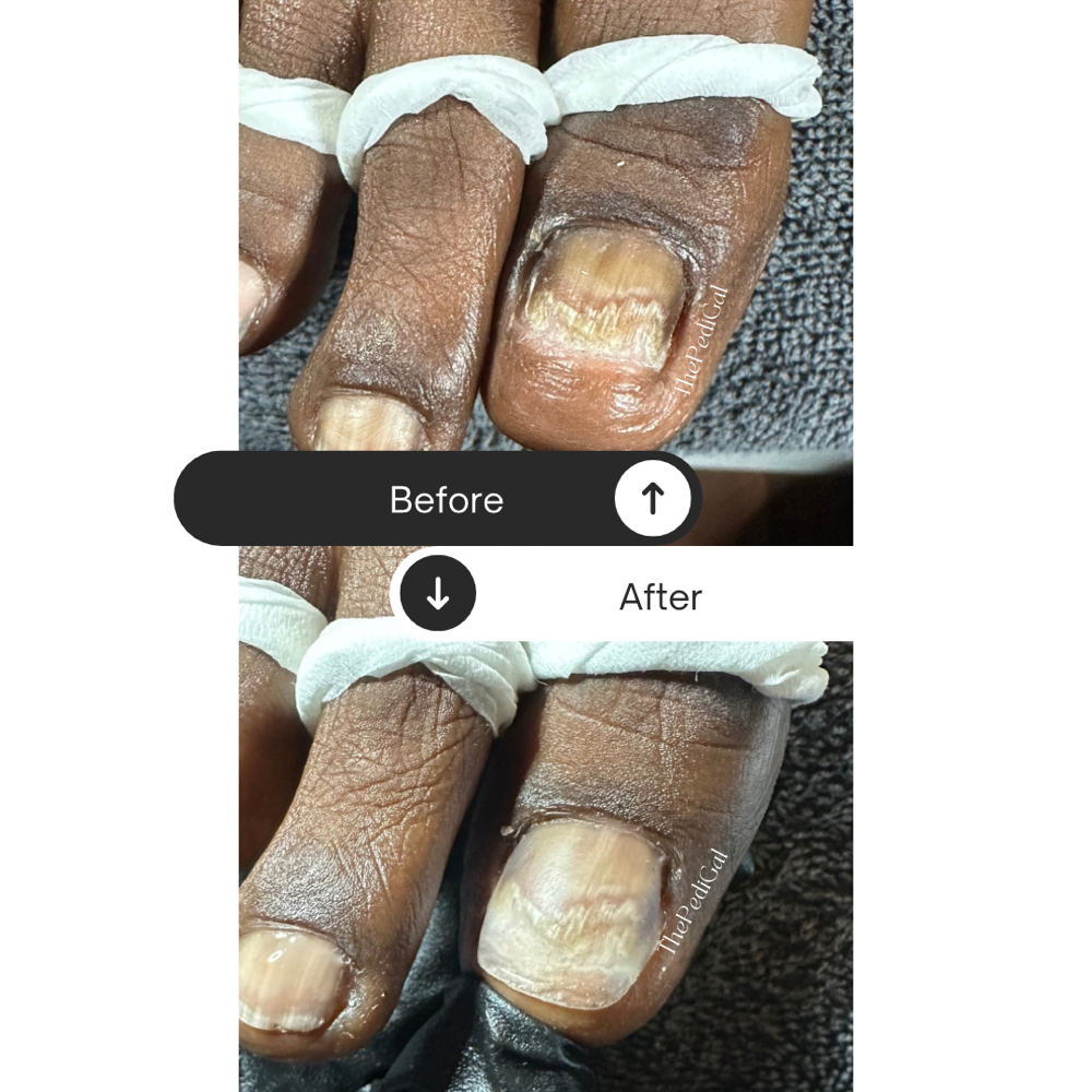 Prostetic Nail Repair