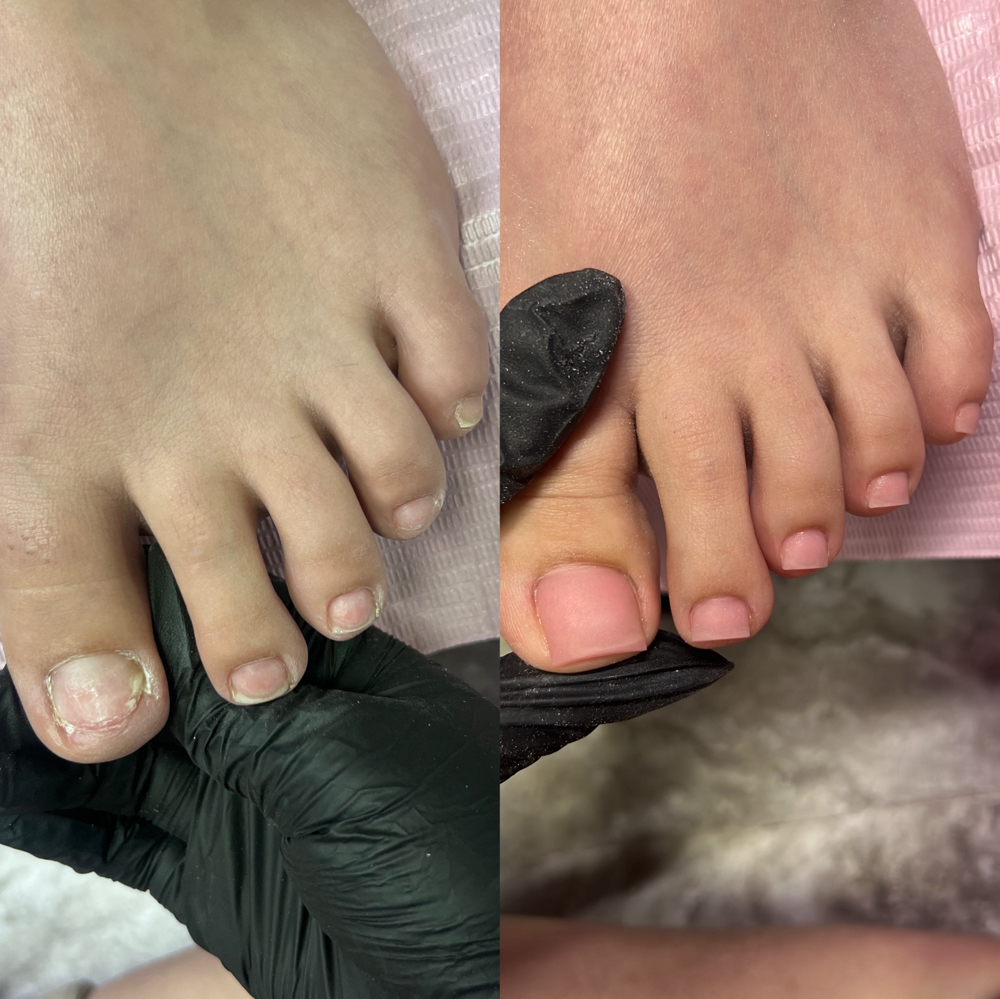 Toe Reconstruction (no fungus)