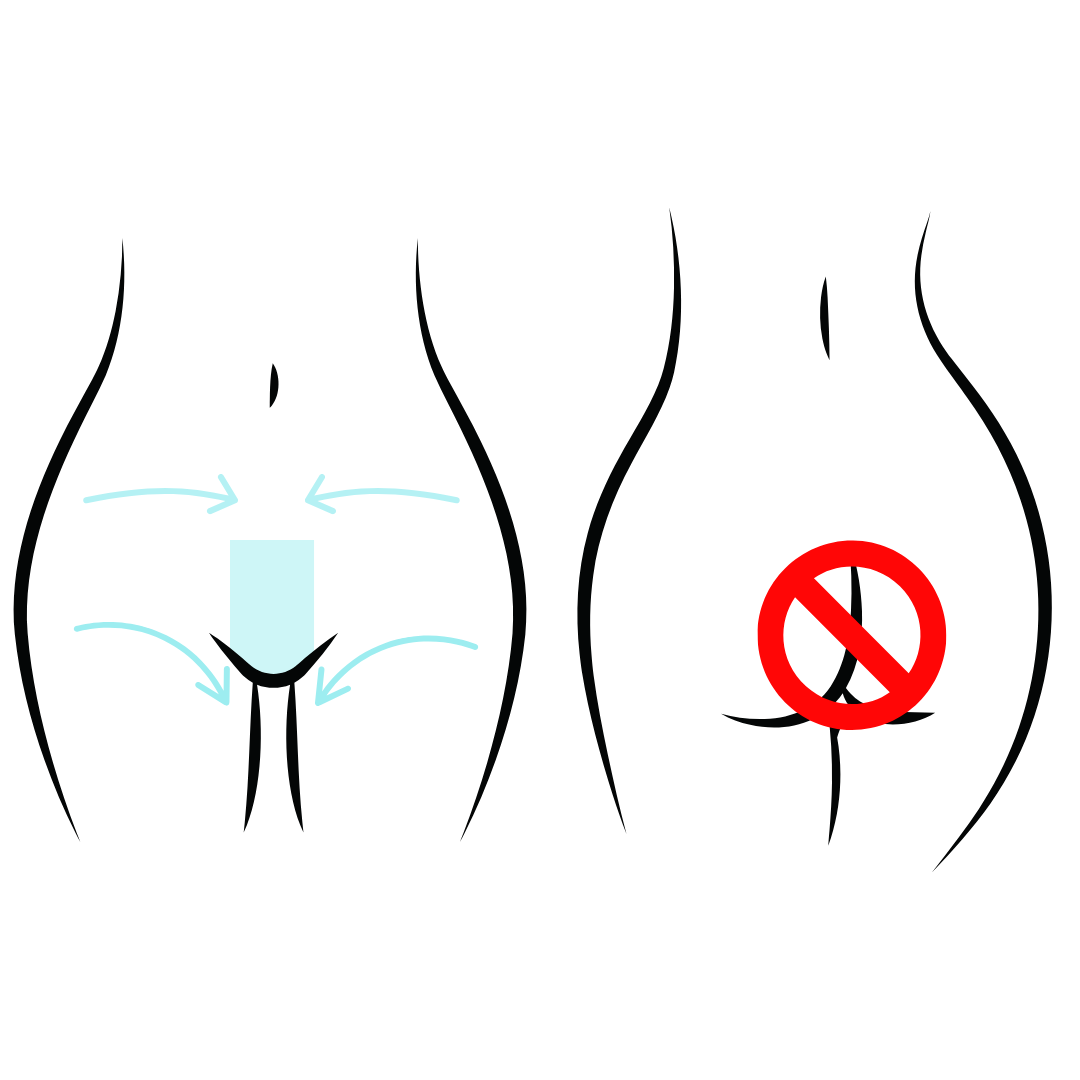 French or Modified Bikini