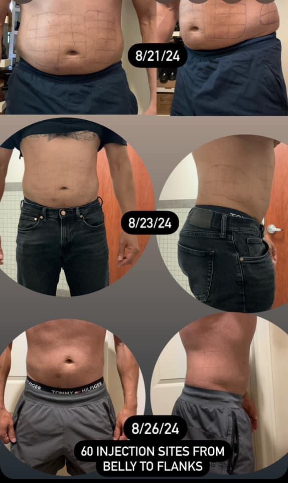 Lipo Dissolve $499
