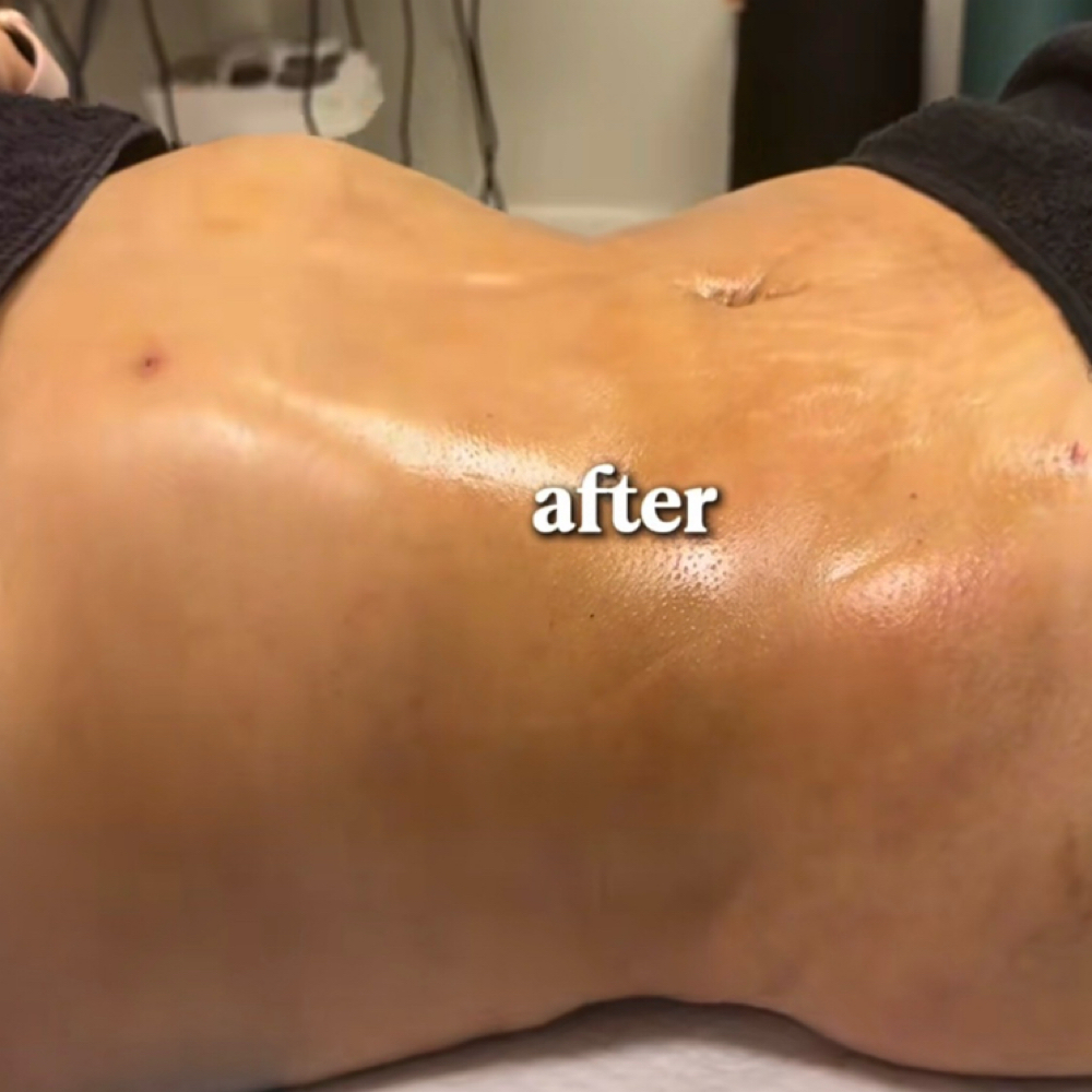 15 Post Lipo Sur Lymphatic massages at Blush in Comfort in Wilbraham, MA