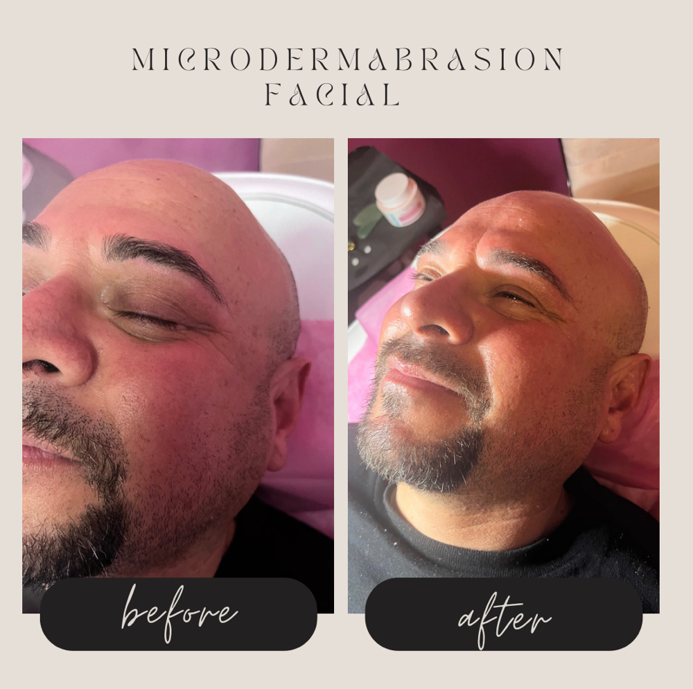 Microdermabrasion Facial