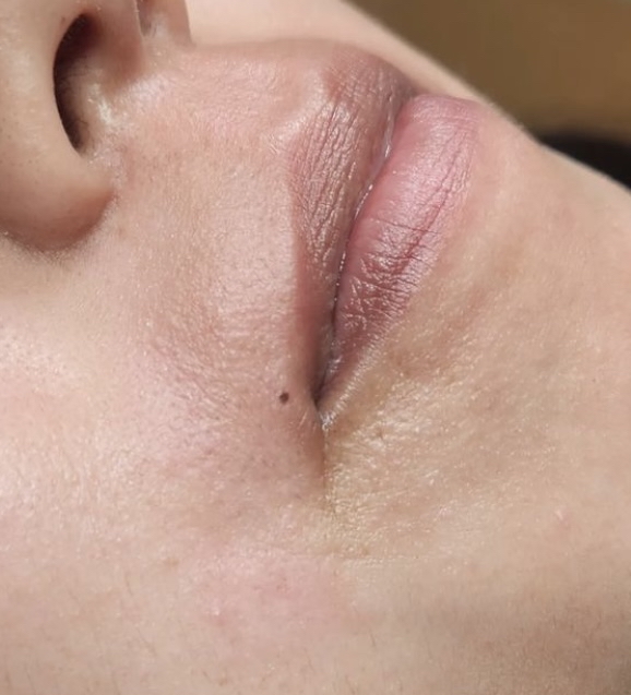 Upper Lip