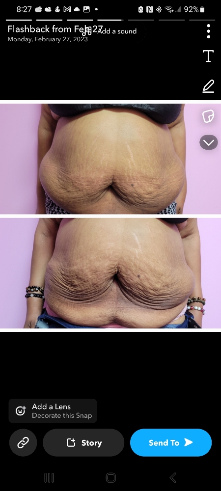 Ultrasound Cavitation