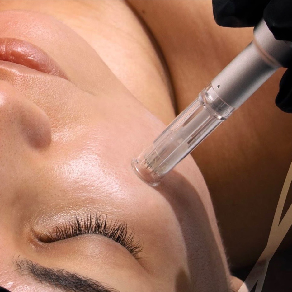 Nano Infusion Refinement at Cara Bella Aesthetics in Temecula, CA