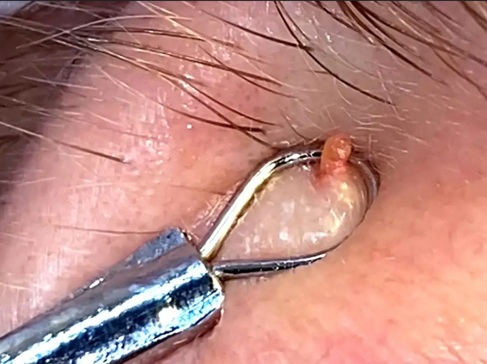 Milia Removal
