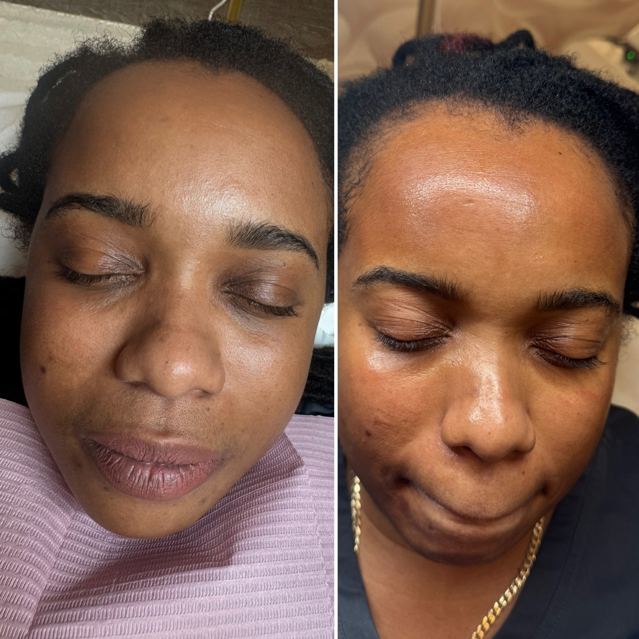 Microneedling at The Rejuvenation Suite Med Spa in New Rochelle, NY