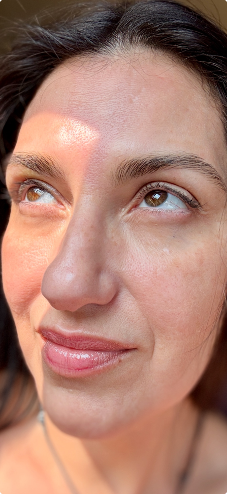 Micro-Needling-HA