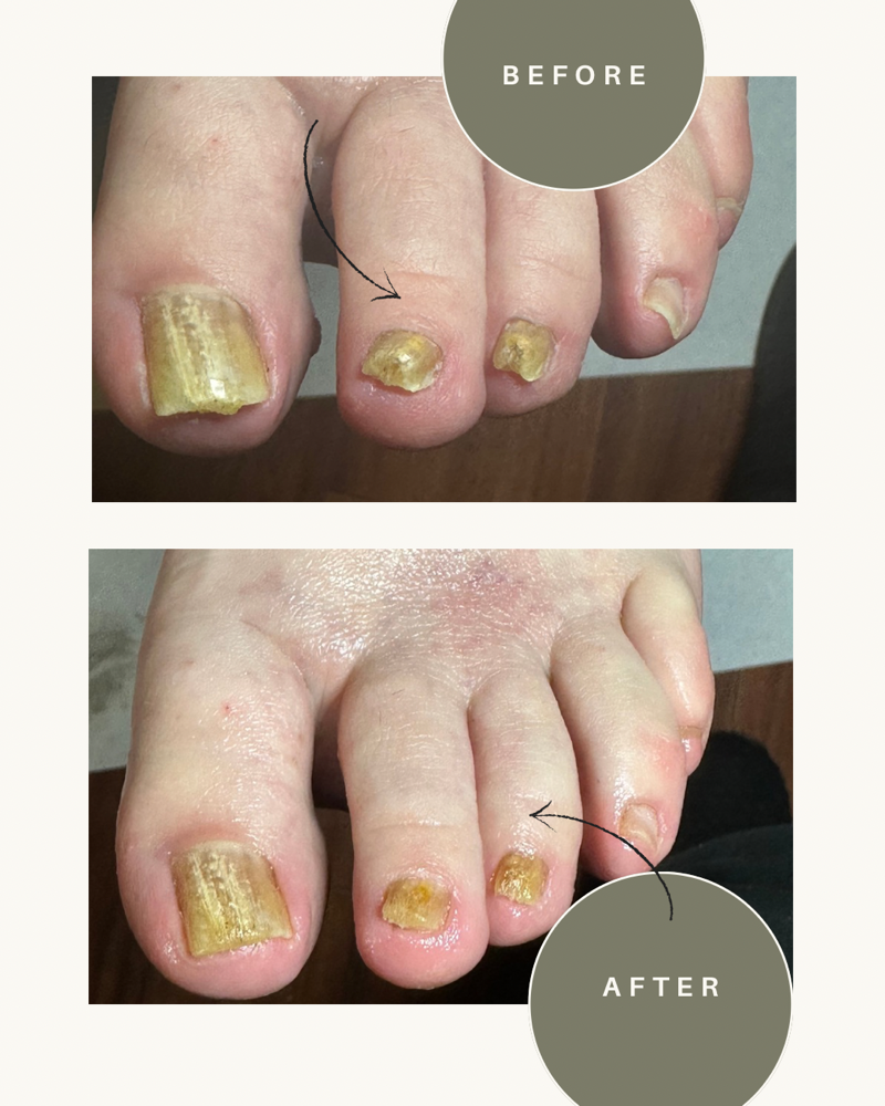 Toe Nail Refinement