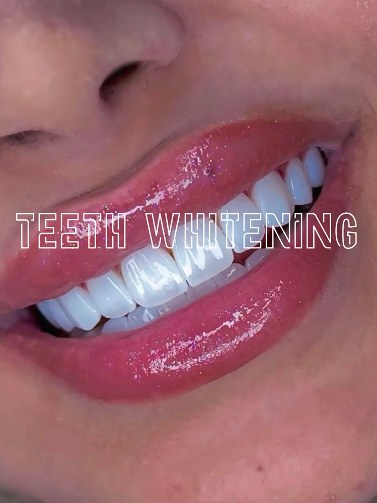 TEETH WHITENING 2ND SESSION